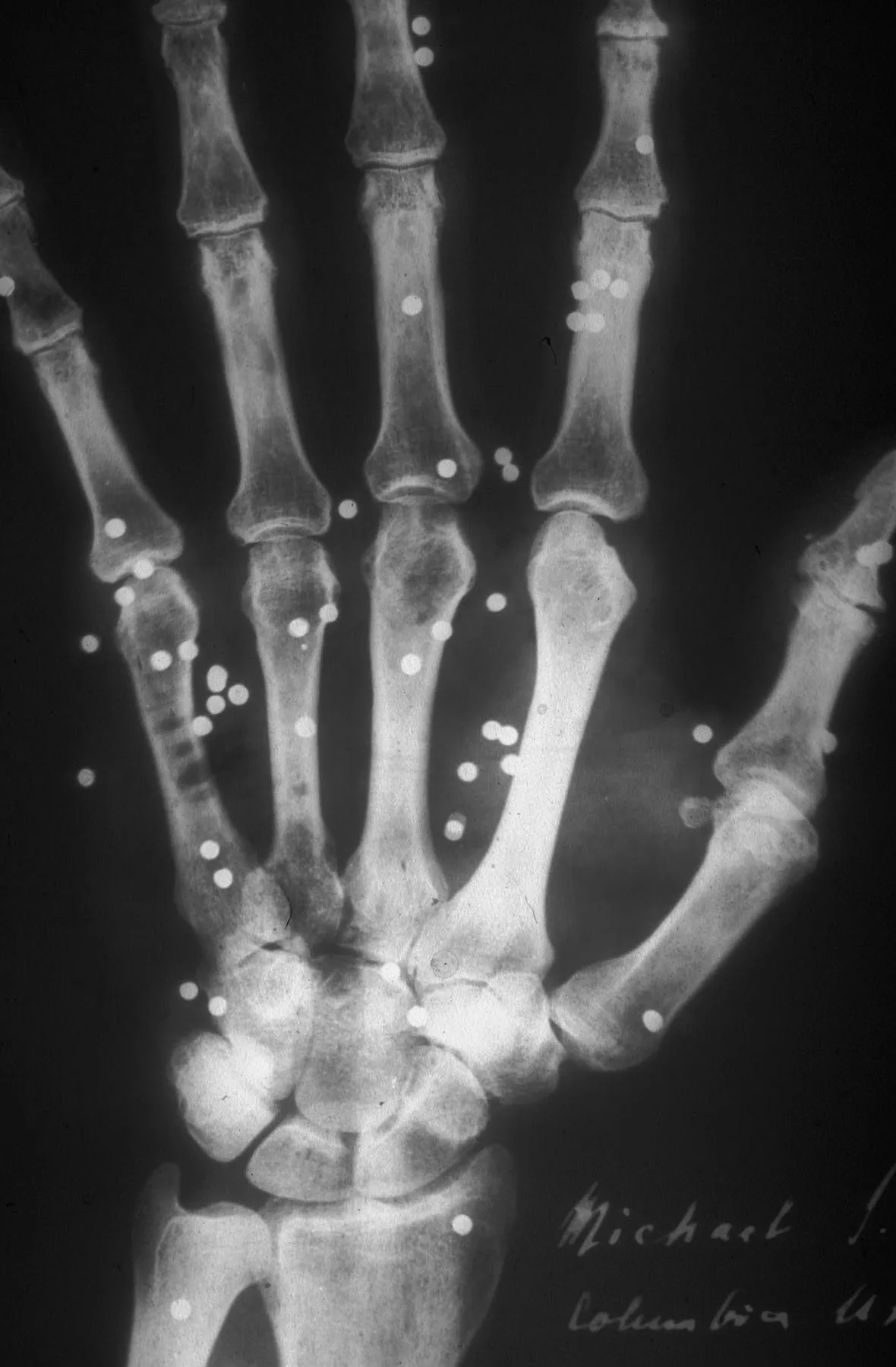Fig. IV — An early 1896 radiograph of a boy's hand, made as physicians began testing the new ray on living bodies.` / credit: `Physikalischer Verein Frankfurt / Wikimedia Commons — public domain.