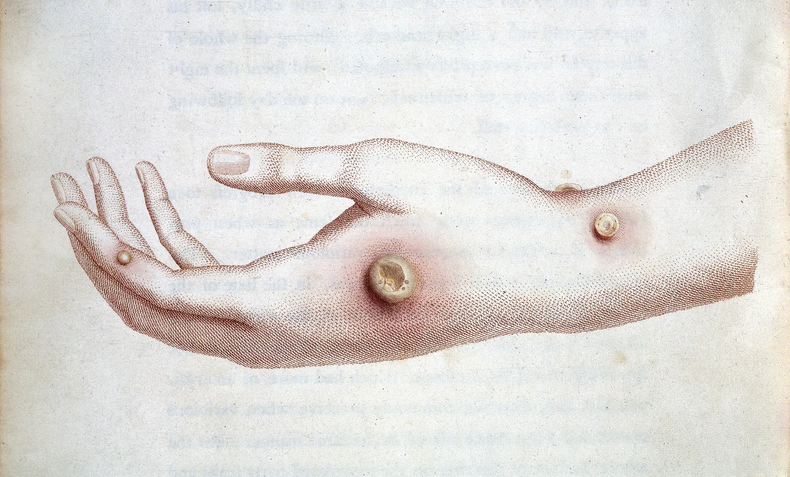 The hand of Sarah Nelmes, showing the cow-pox pustules, hand-coloured plate from Jenner's *An Inquiry into the Causes and Effects of the Variolae Vaccinae* (1798). Wellcome Collection, CC BY 4.0. WP media **518**.