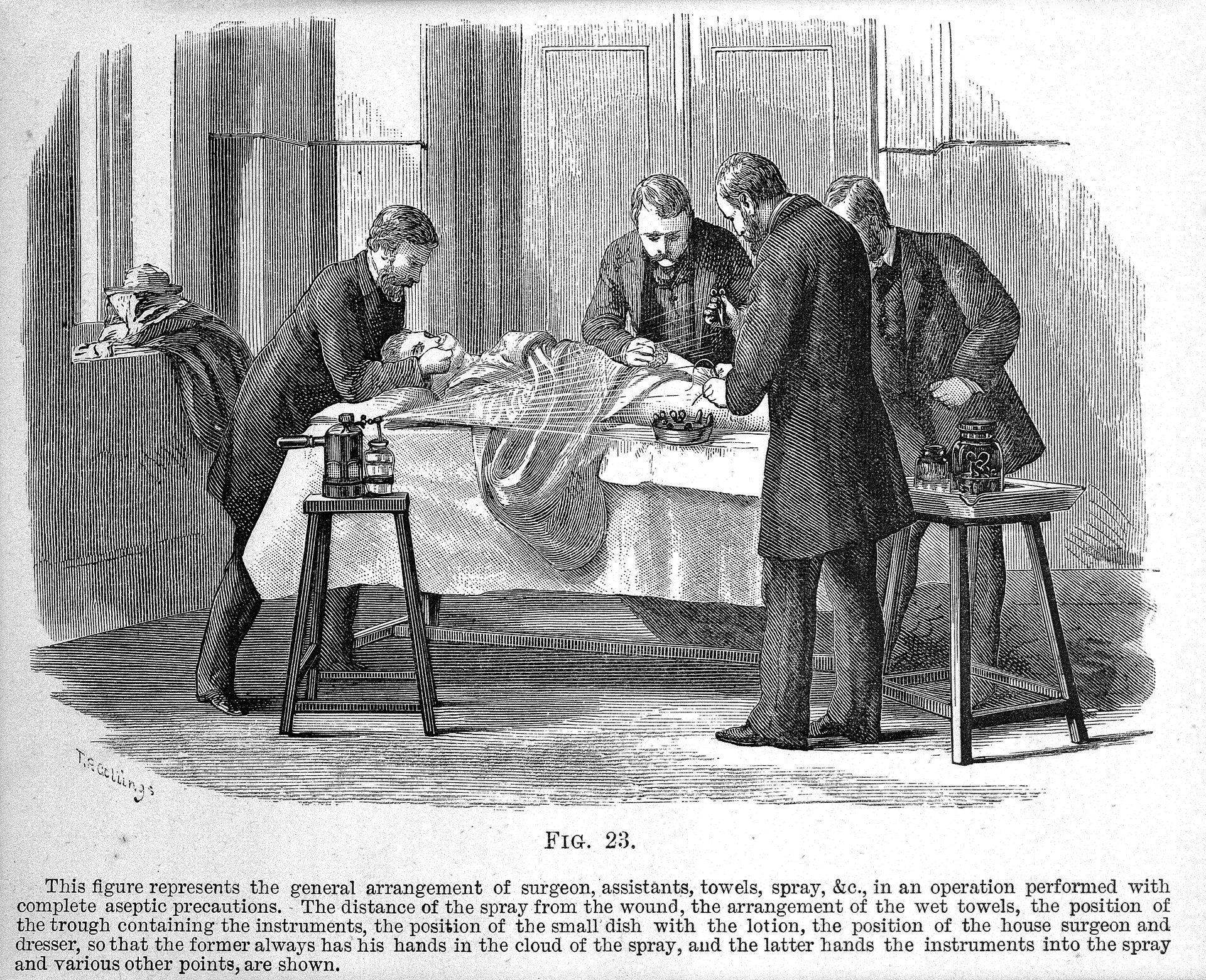 Wood engraving of Lister's carbolic spray being used over an operation.