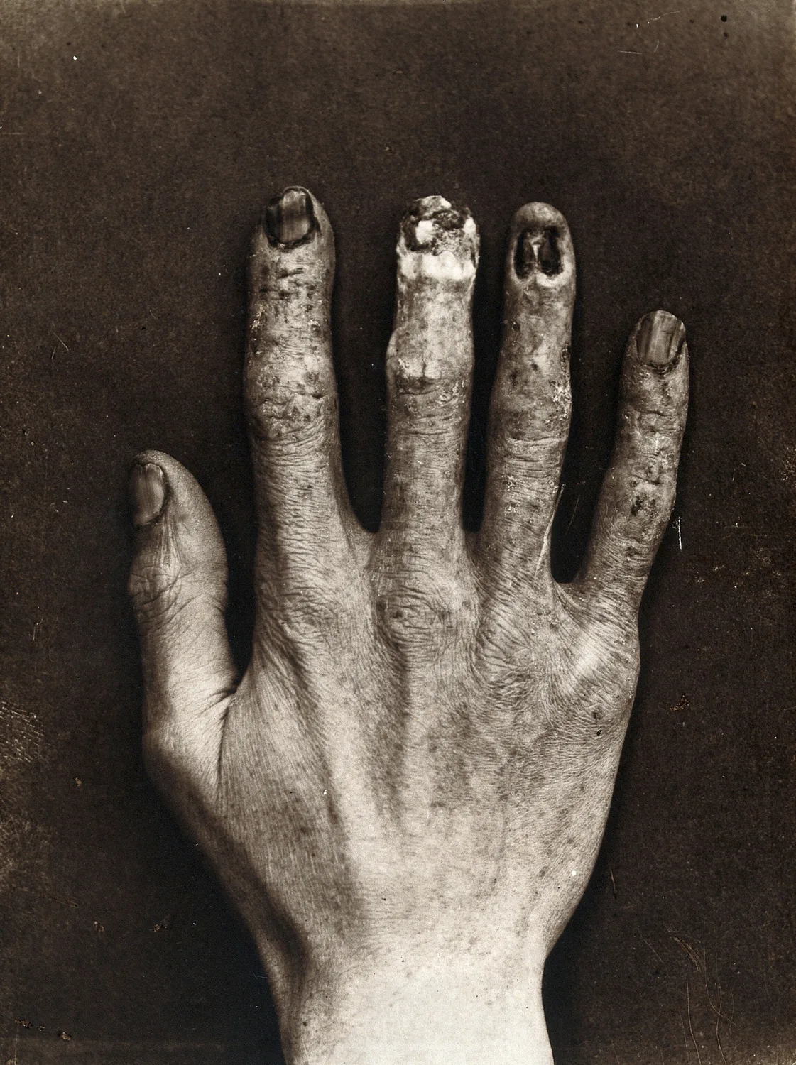 Fig. III — An early X-ray dermatitis injury: the damaged hand of a technician who had worked habitually with X-ray apparatus. The first operators learned that the ray was spent upon whatever stopped it.` / credit: `Wellcome Collection - Public Domain Mark.