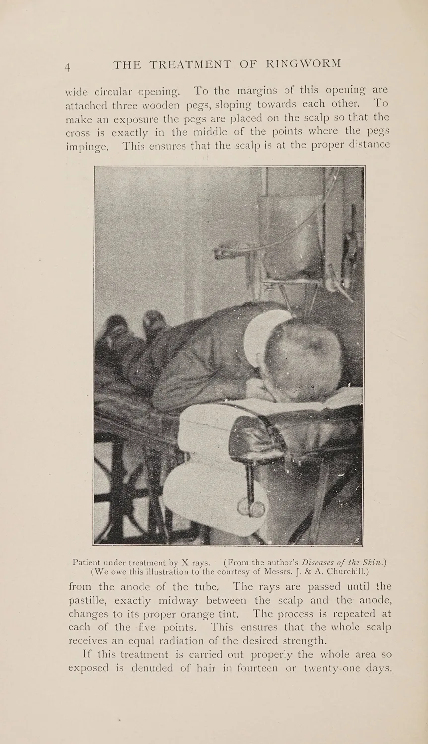 Fig. IV — A child positioned for X-ray epilation of the scalp in the treatment of ringworm — a use that dosed the brain beneath in order to clear the hair above.` / credit: `Wellcome Collection - Public Domain Mark.