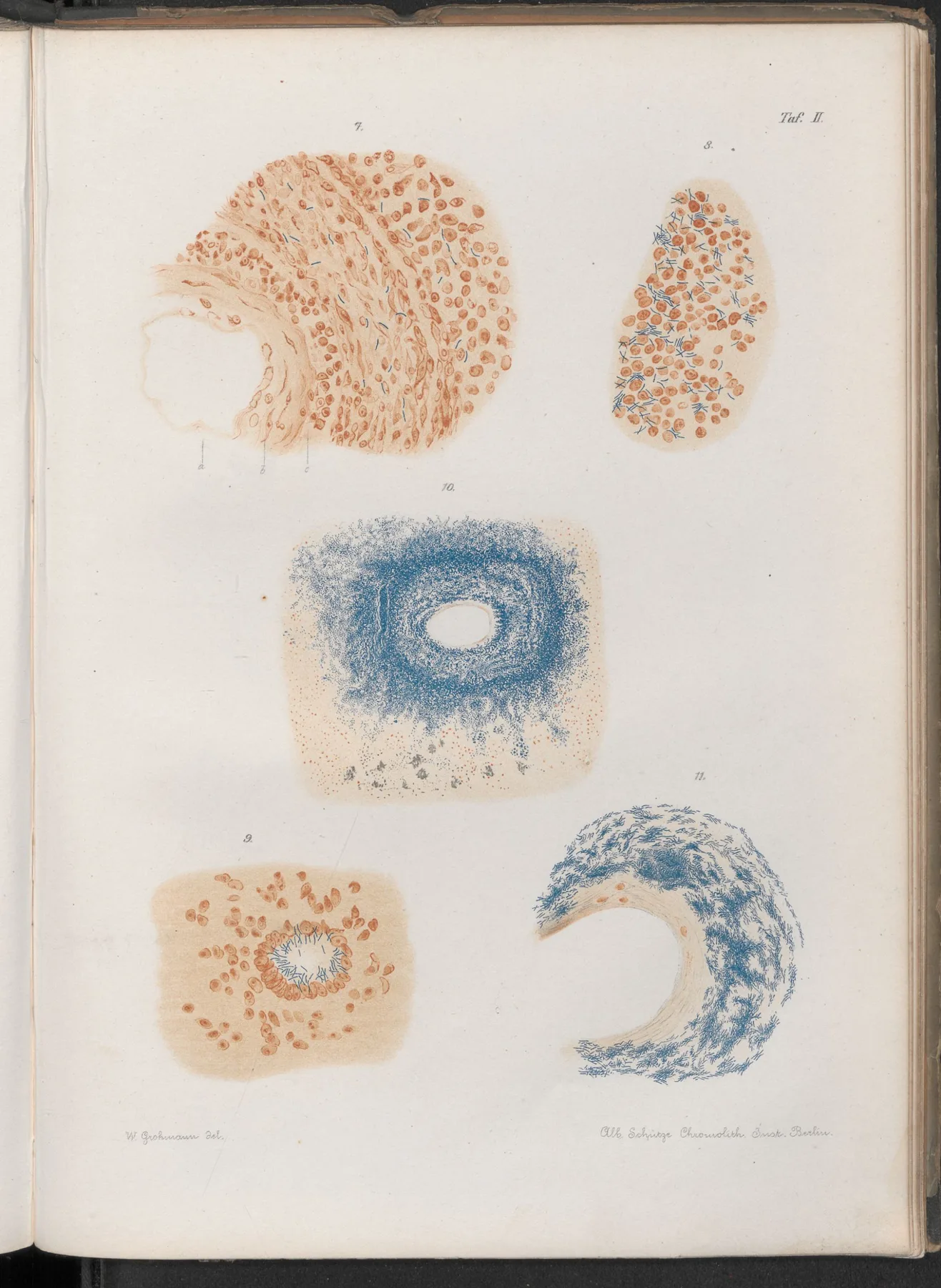Koch's chromolithographic plate of tuberculous tissue, from his expanded 1884 report on the aetiology of tuberculosis. Humboldt-Universitat zu Berlin digi-hub, public domain scan. WP media **508**.